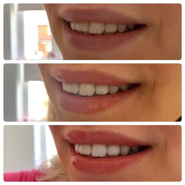 Ultimate Teeth Whitening Set