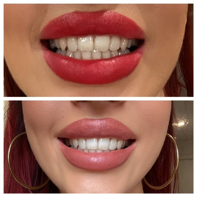 SmileTime Teeth Whitening Before and After Result